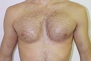 http://andrology.kz/upload/dieases/breast12.jpg